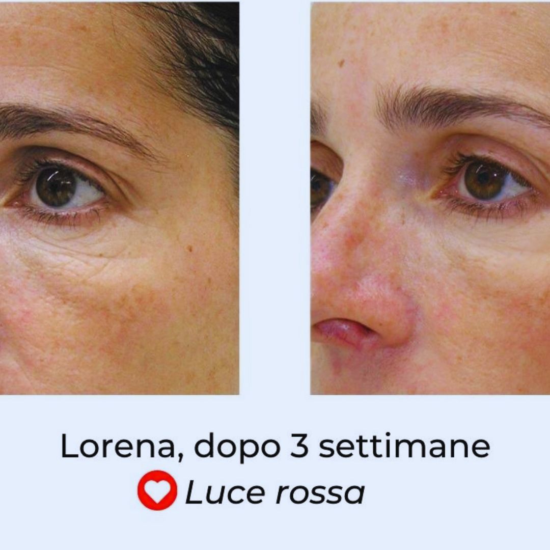 Dispositivo LED viso funziona davvero Tutto quello che devi sapere prima di iniziare